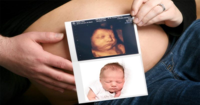 3D / 4D Ultrasound Scan